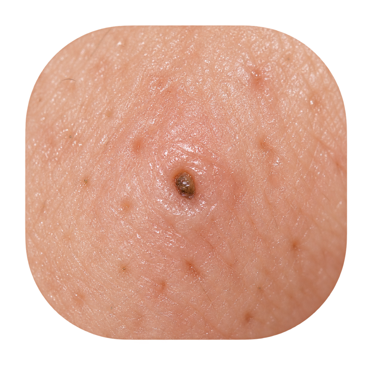 Clogged Pore