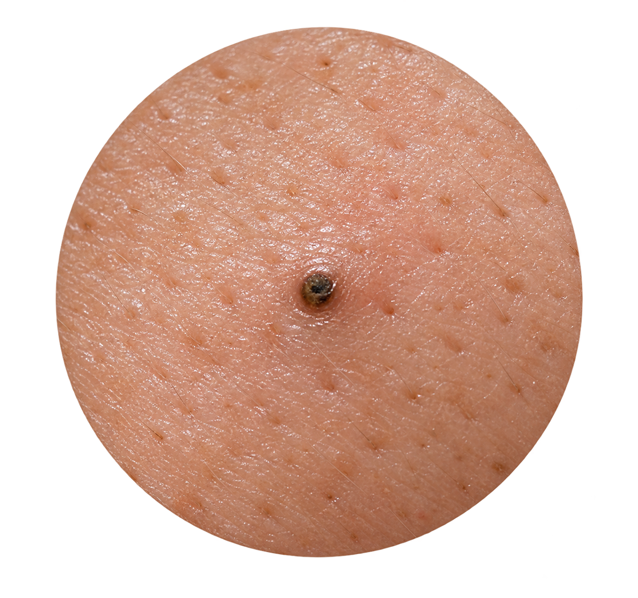 Blackhead and whitehead