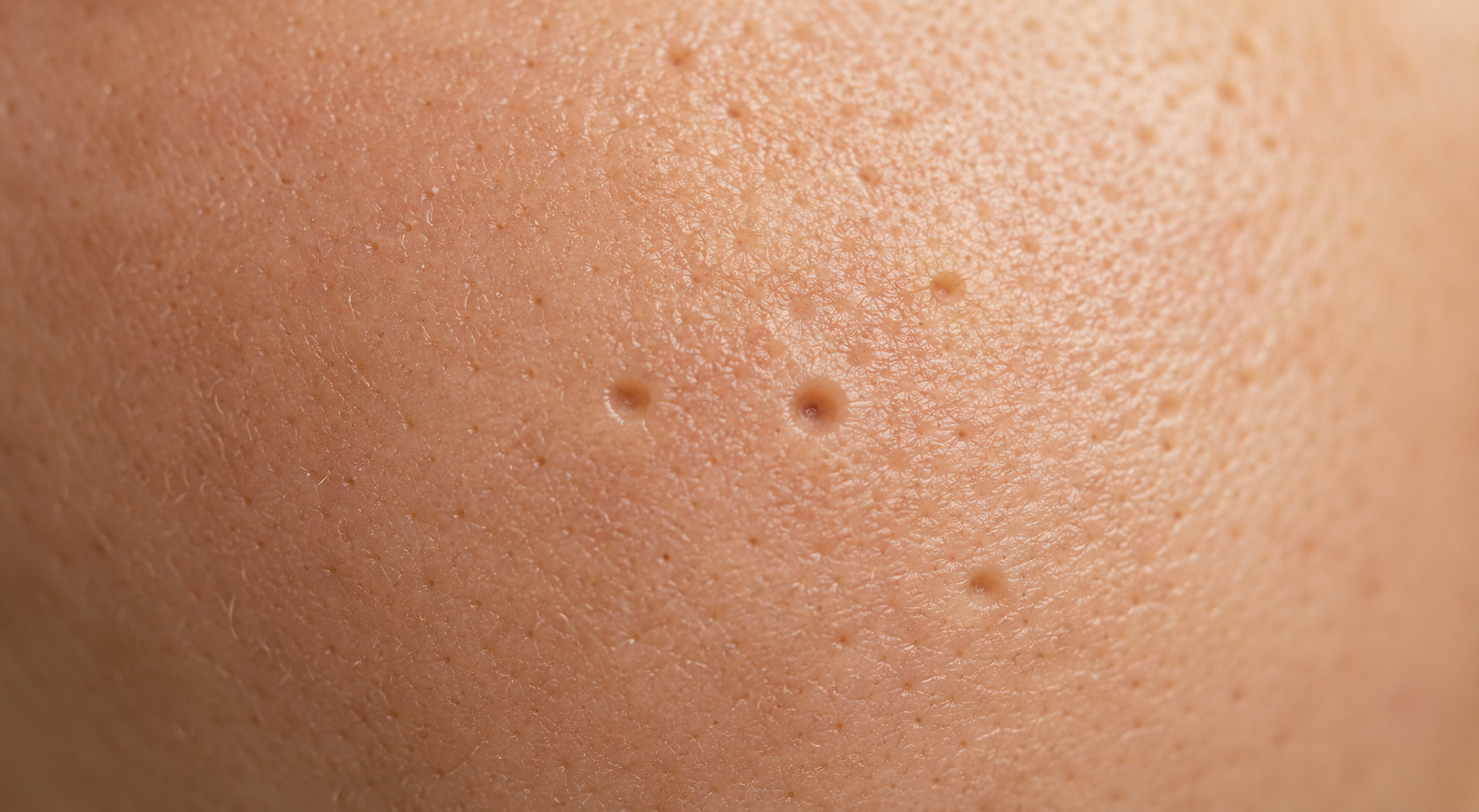 More visible enlarged pores