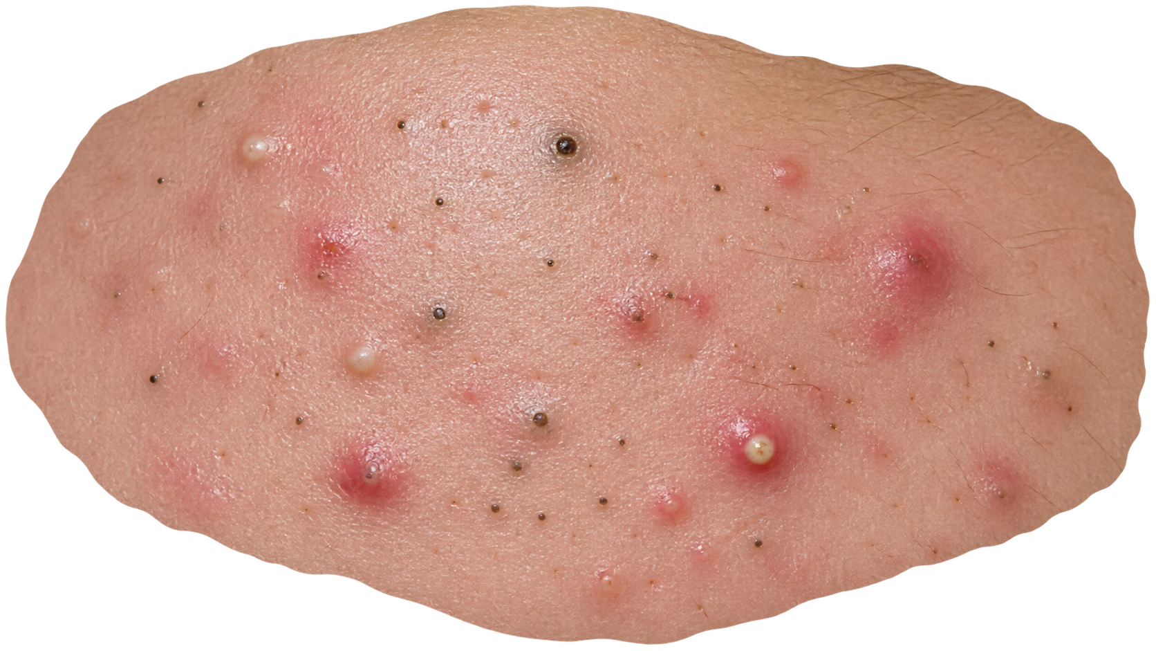 Acne Vulgaris