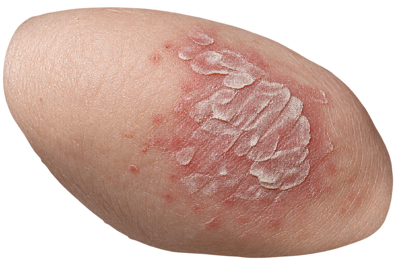 Psoriasis and gut health research