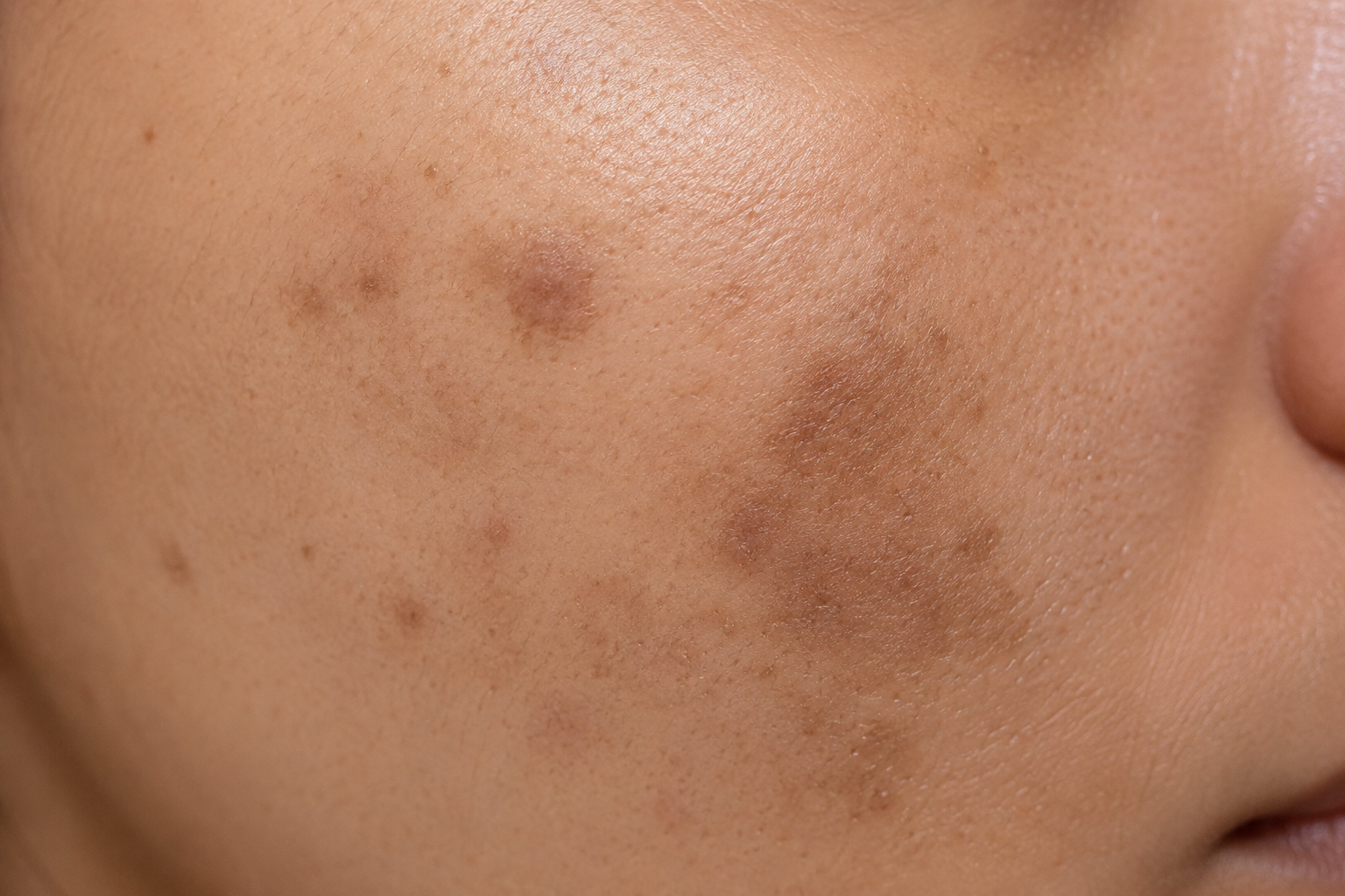 Hyperpigmentation illustration