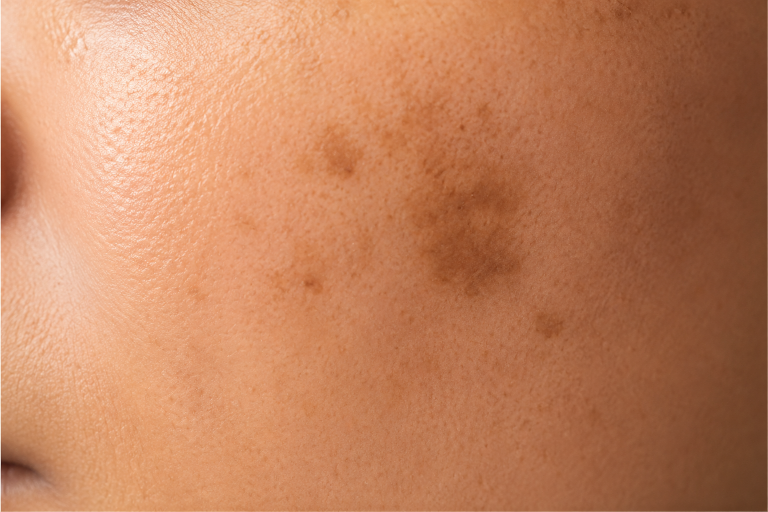 Illustration showing hyperpigmentation on facial skin