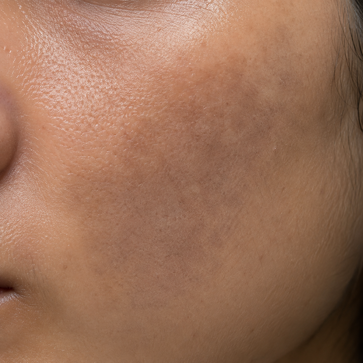 Dermal Melasma