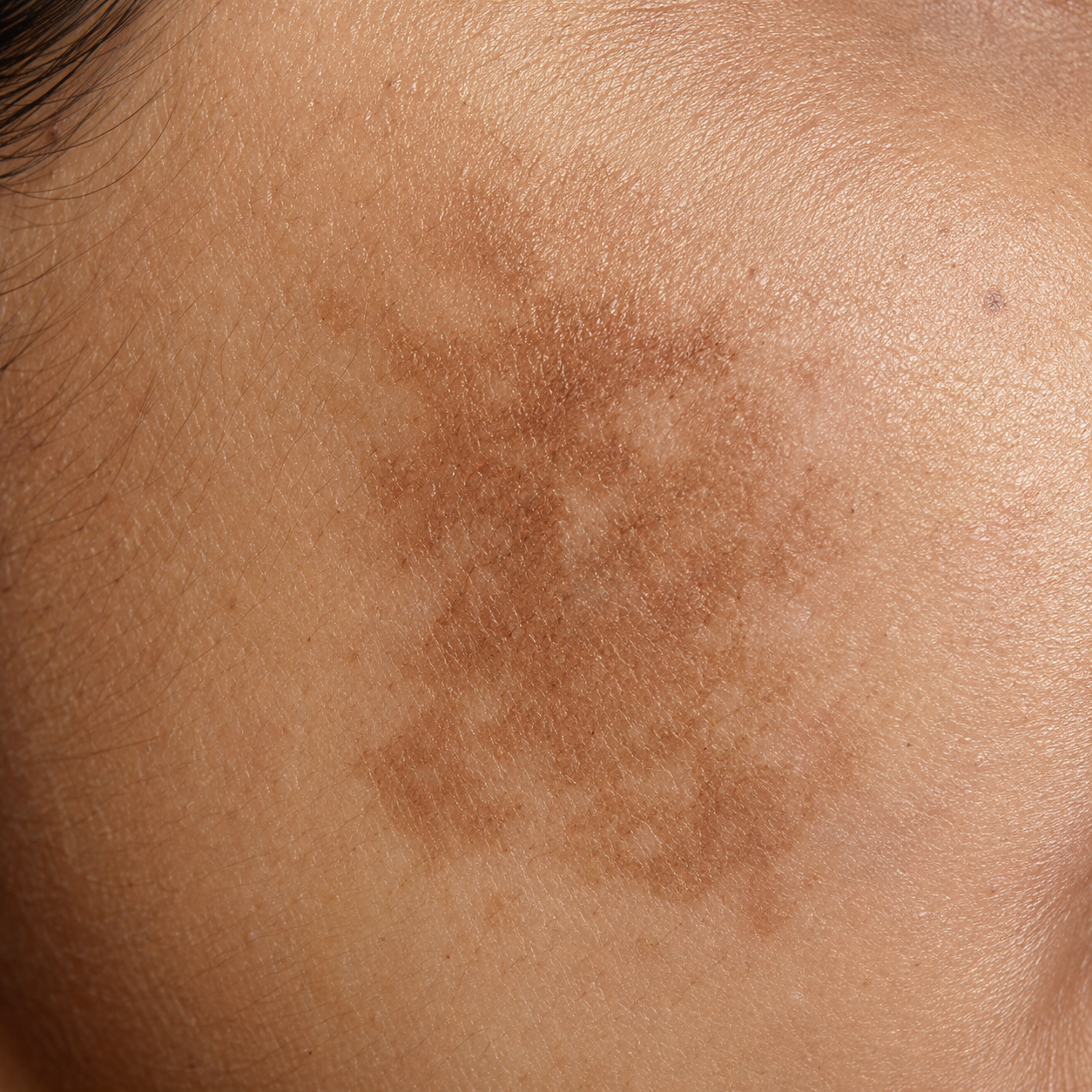 Epidermal Melasma