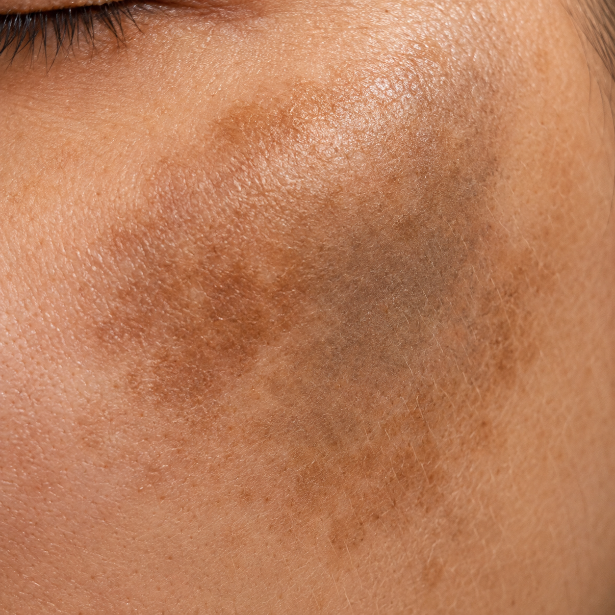Mixed Melasma