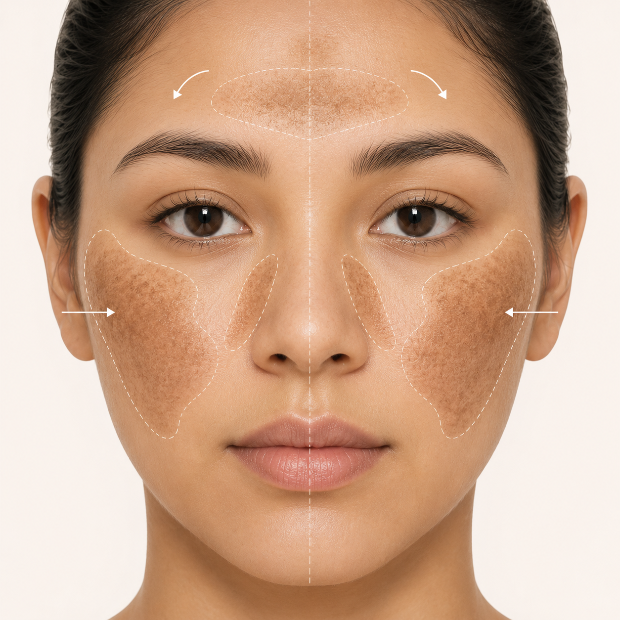 Melasma patches