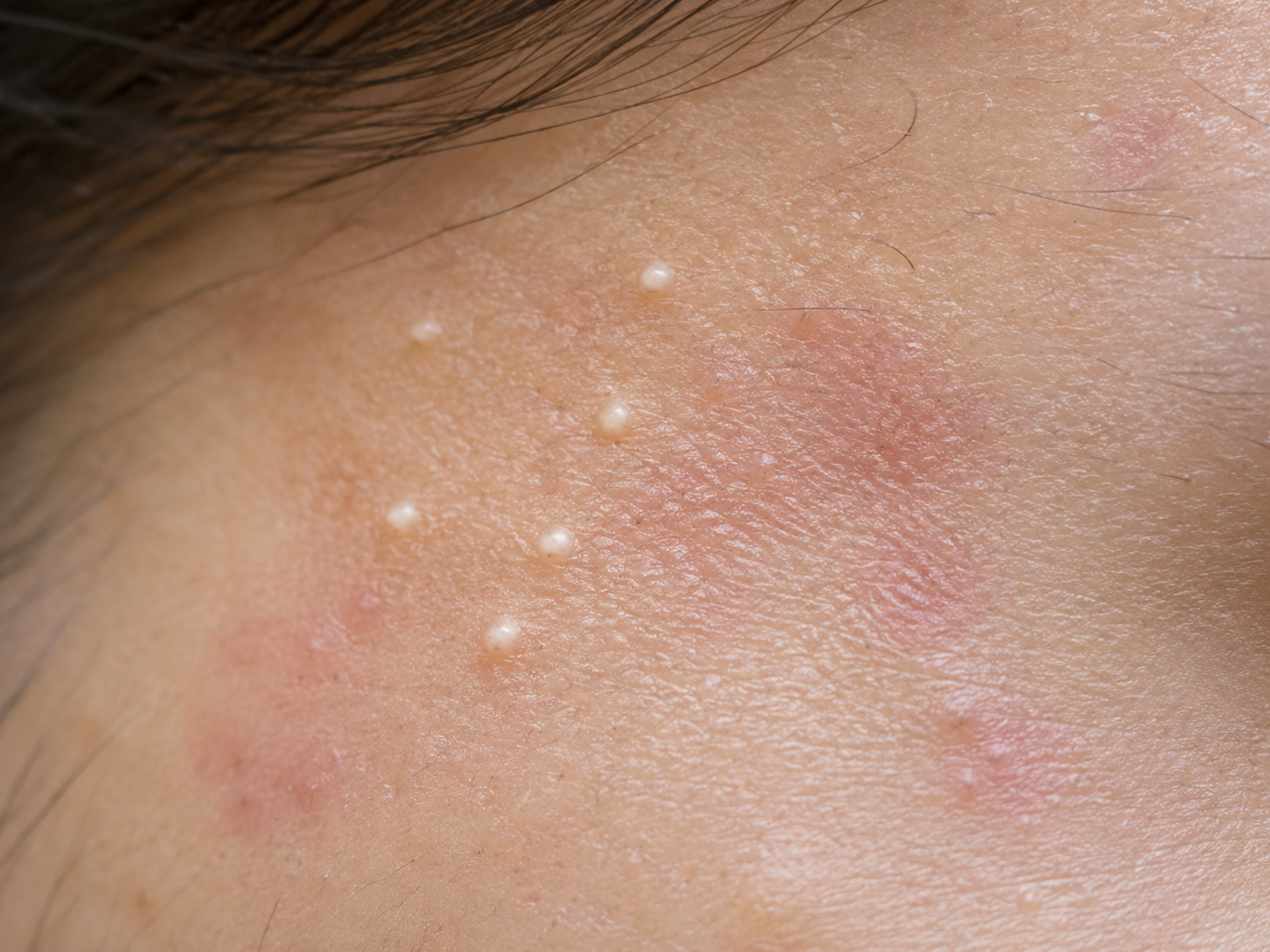 Secondary milia illustration