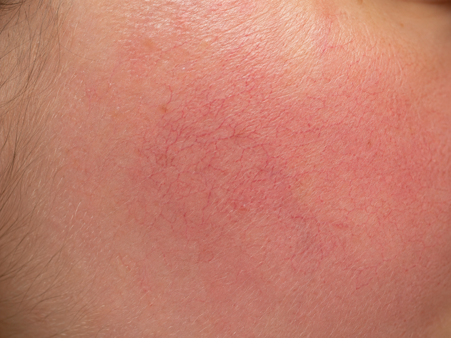 Illustration representing erythematotelangiectatic rosacea
