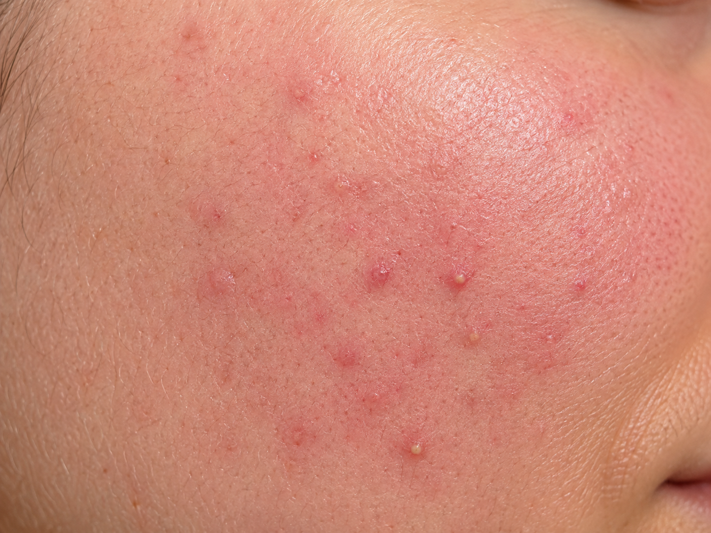 Illustration representing papulopustular rosacea