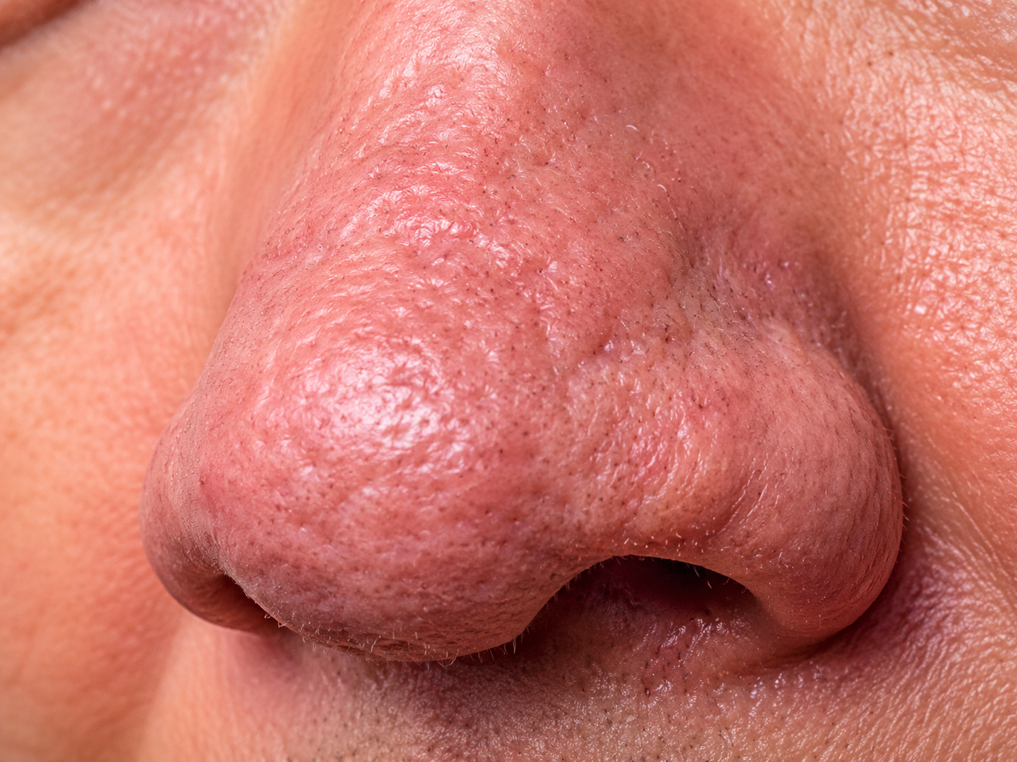 Illustration representing phymatous rosacea